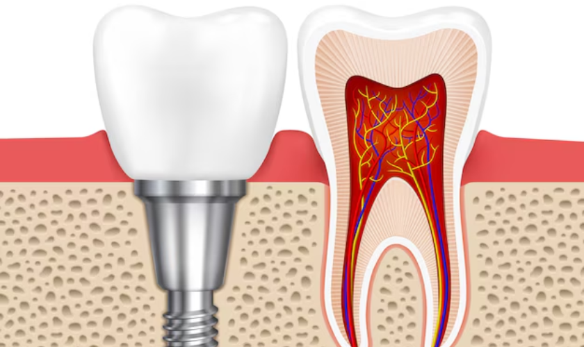 Recovery Time For Dental Implants