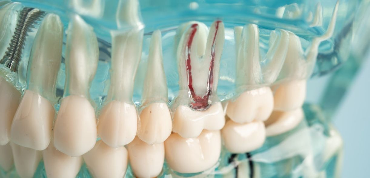 Steps Are There In A Root Canal