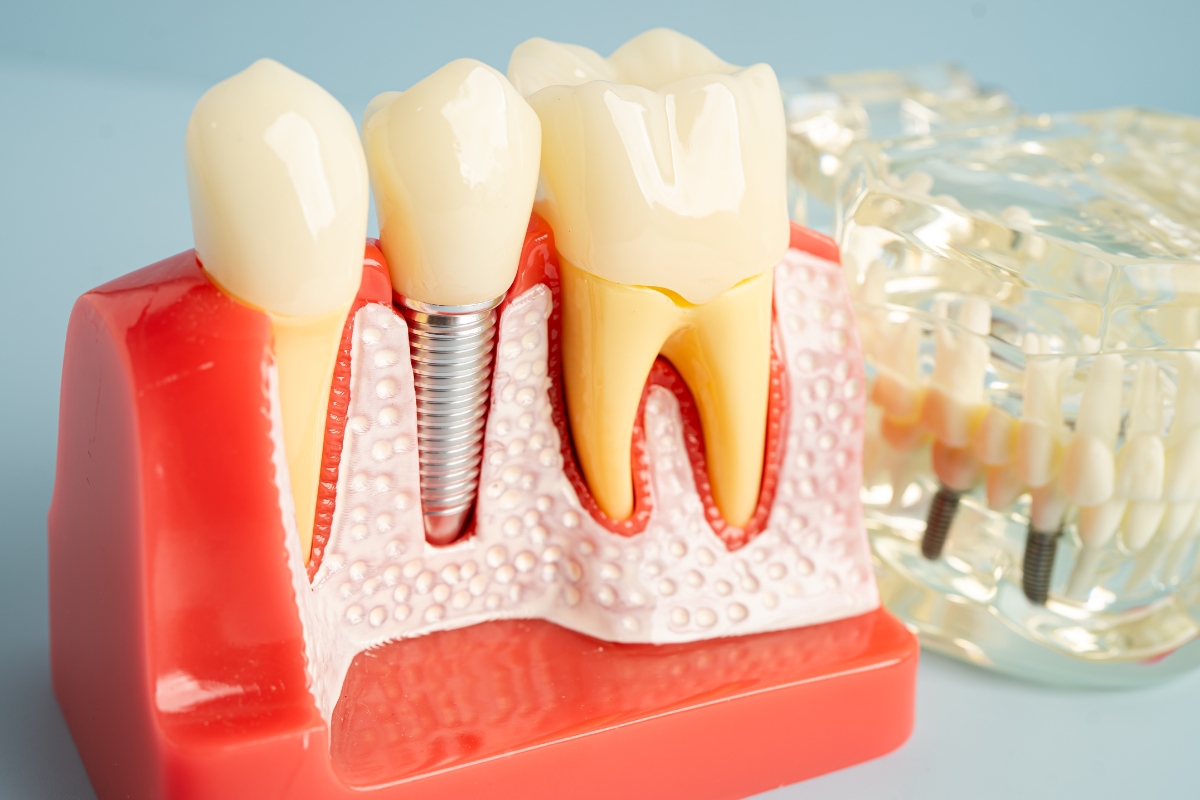 Dental Implants Amherst - Amherst Neighborhood Dentistry