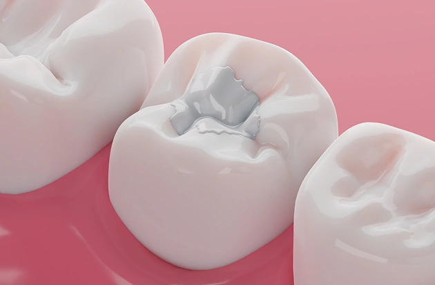 Dental Fillings