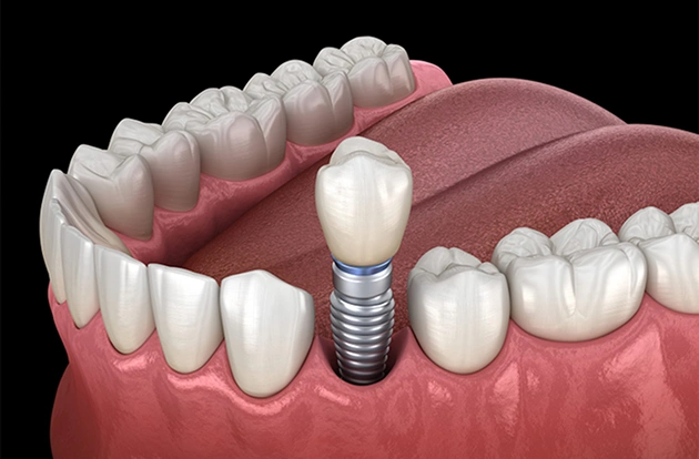 Dental Implants