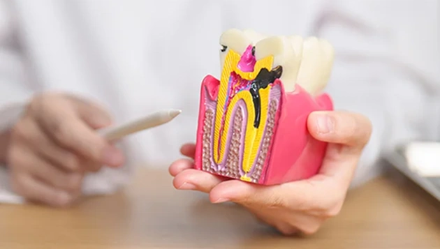 Root Canal Therapy